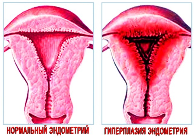 Гиперплазия эндометрия
